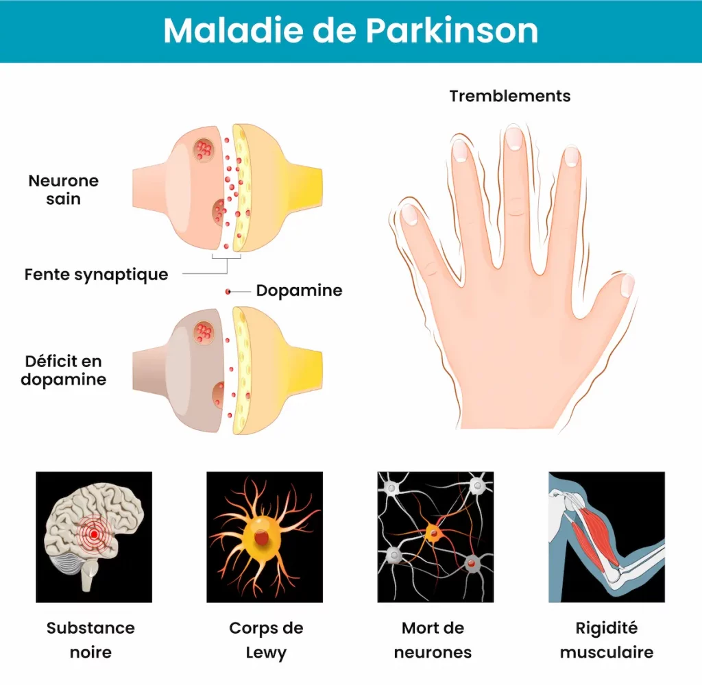 Schéma détaillant le mécanisme qui détruit les neurones d'une personne atteinte de la maladie de parkinson.