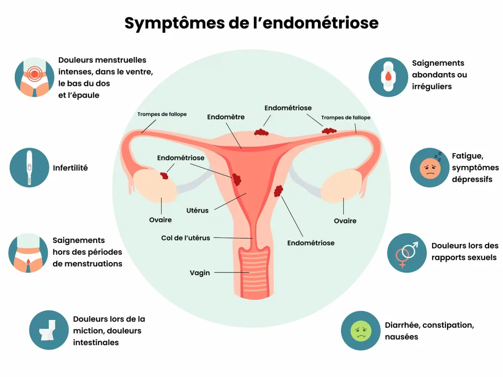 Infographie qui répertorie les symptômes de l'endométriose.