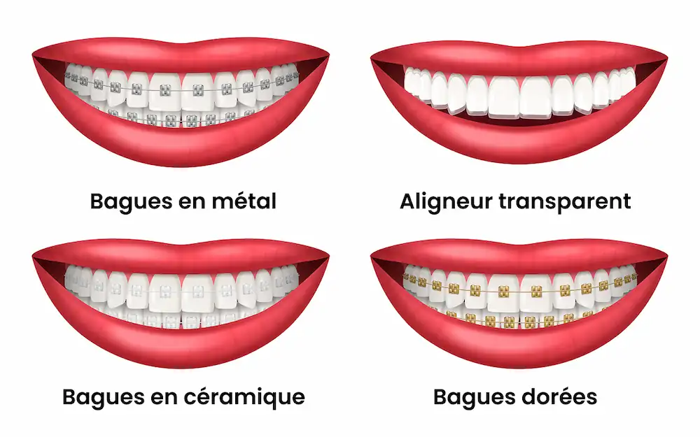 Plusieurs techniques existent pour des traitements d'orthodontie pour adulte.