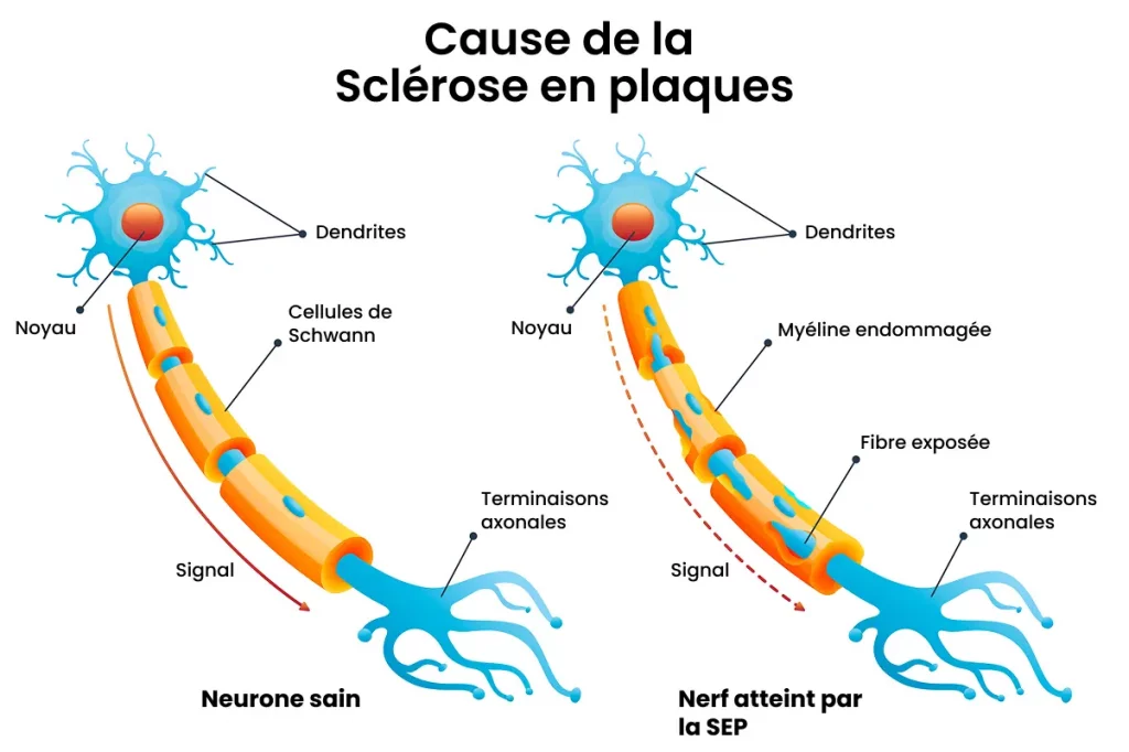La sclérose en plaques trouve sa source dans l'endommagement de la myéline.