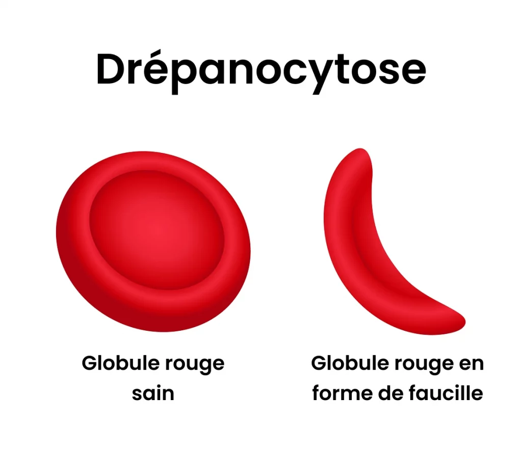 La drépanocytose affecte les globules rouges en modifiant leur forme.