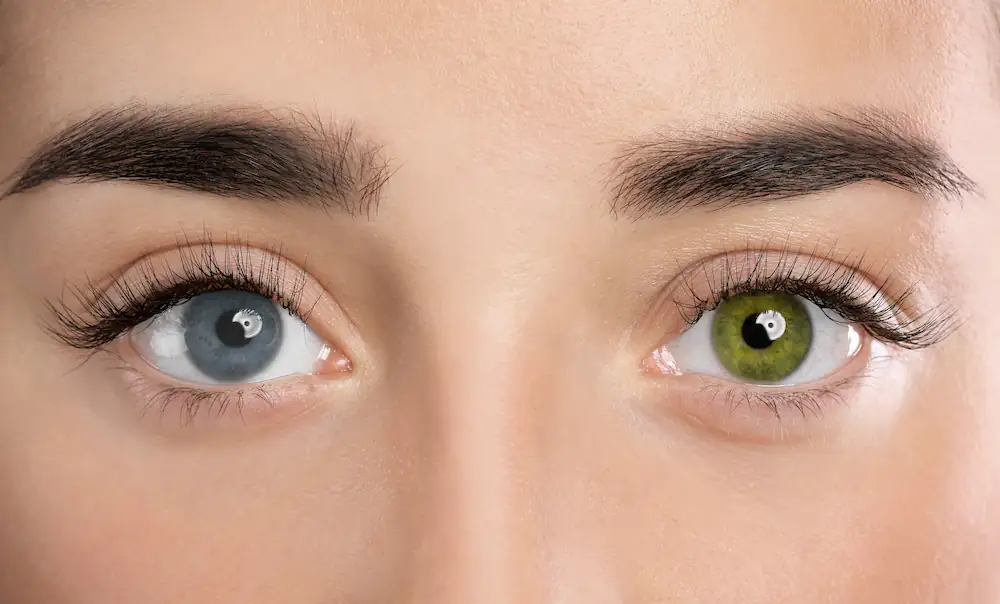 Illustration des yeux vairons : un œil bleu et un œil vert.